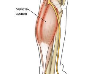 Will CBD Help With Muscle Spasms?