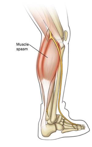 Will CBD Help With Muscle Spasms?